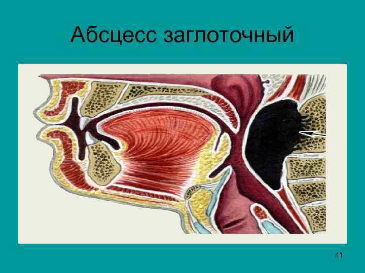 Абсцесс заглоточный 41 