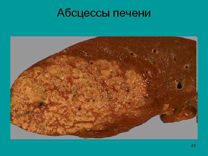 Абсцессы печени 43 