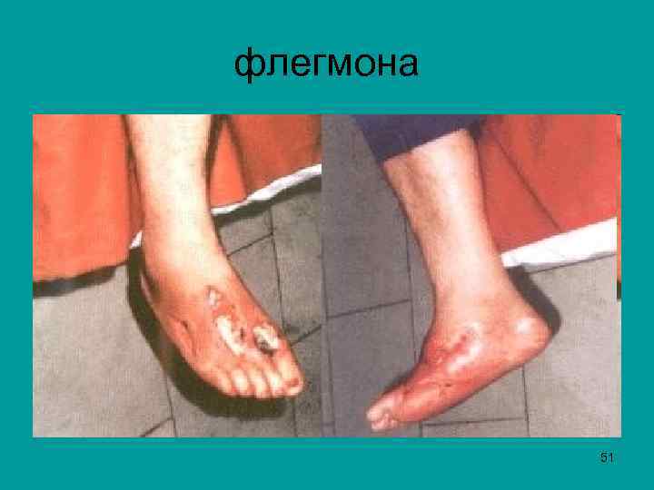 флегмона 51 