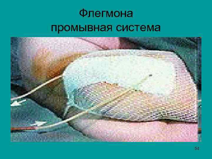 Флегмона промывная система 54 