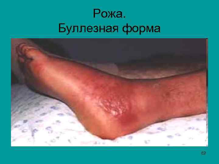 Рожа. Буллезная форма 62 