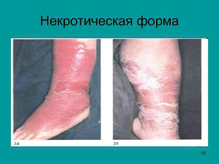Некротическая форма 65 