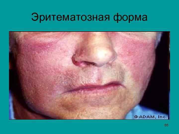 Эритематозная форма 66 