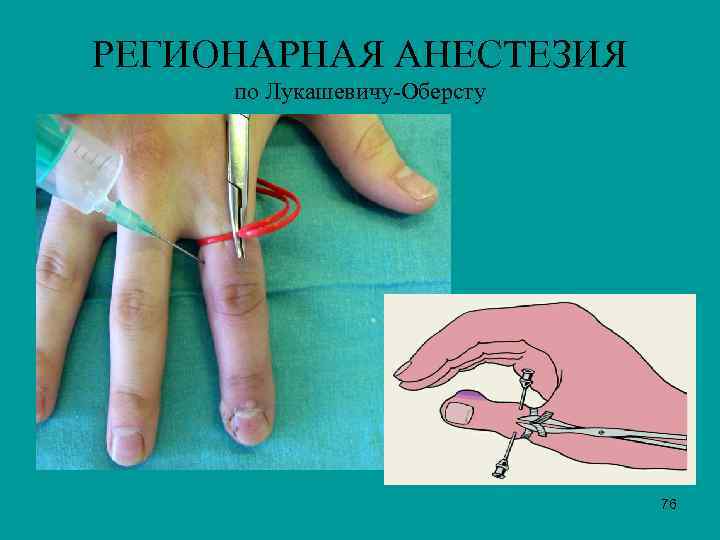 РЕГИОНАРНАЯ АНЕСТЕЗИЯ по Лукашевичу-Оберсту 76 