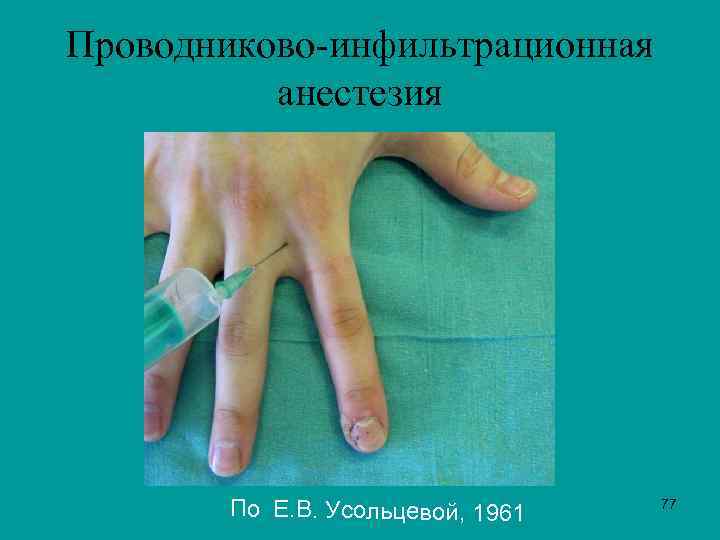 Проводниково-инфильтрационная анестезия По Е. В. Усольцевой, 1961 77 