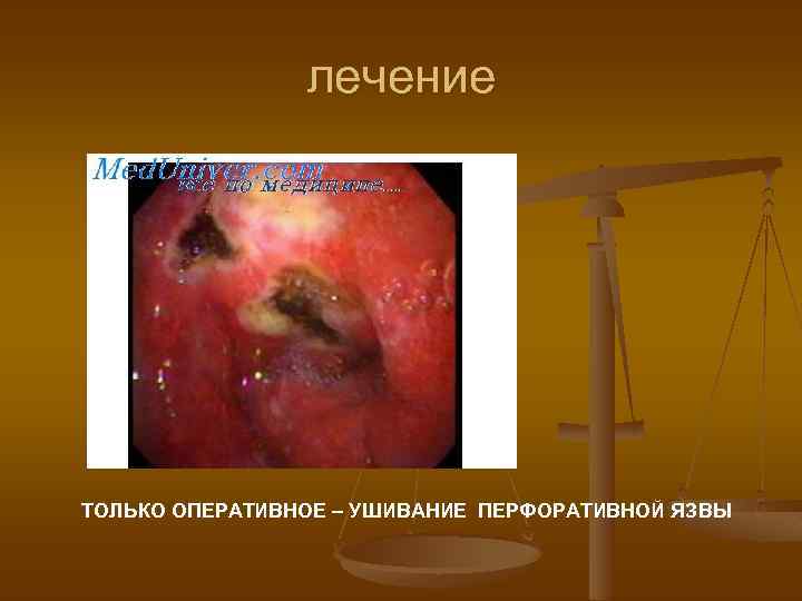 лечение ТОЛЬКО ОПЕРАТИВНОЕ – УШИВАНИЕ ПЕРФОРАТИВНОЙ ЯЗВЫ 