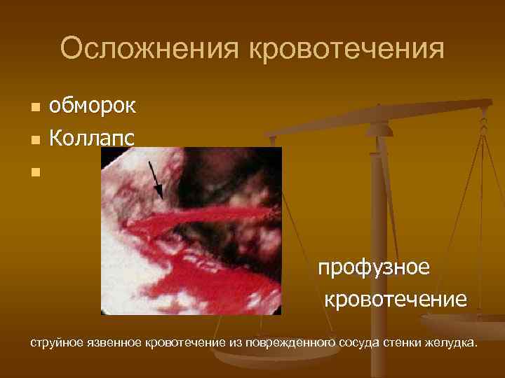 Осложнения кровотечения n n обморок Коллапс n профузное кровотечение струйное язвенное кровотечение из поврежденного