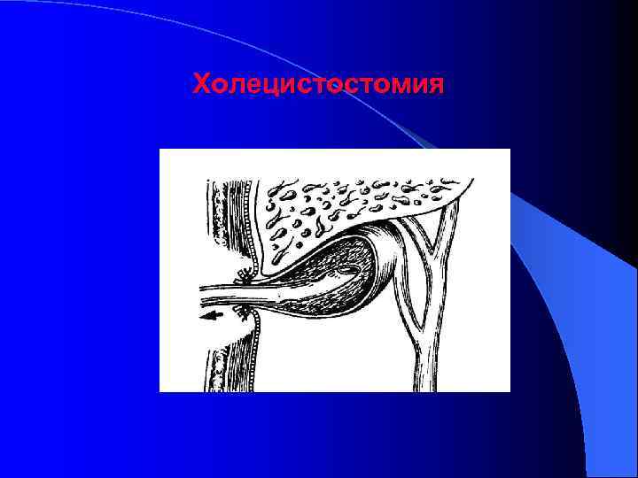 Холецистостомия 