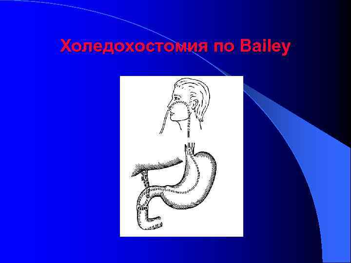 Холедохостомия по Bailey 