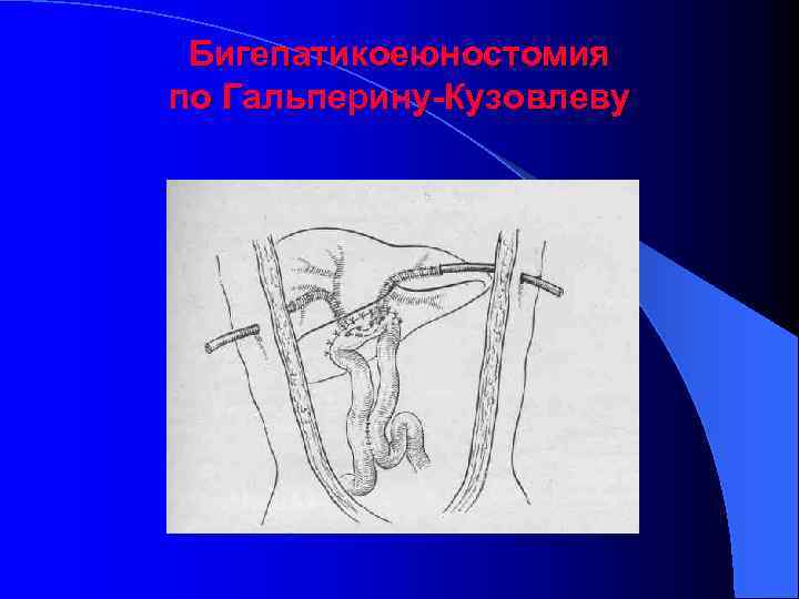 Бигепатикоеюностомия по Гальперину-Кузовлеву 