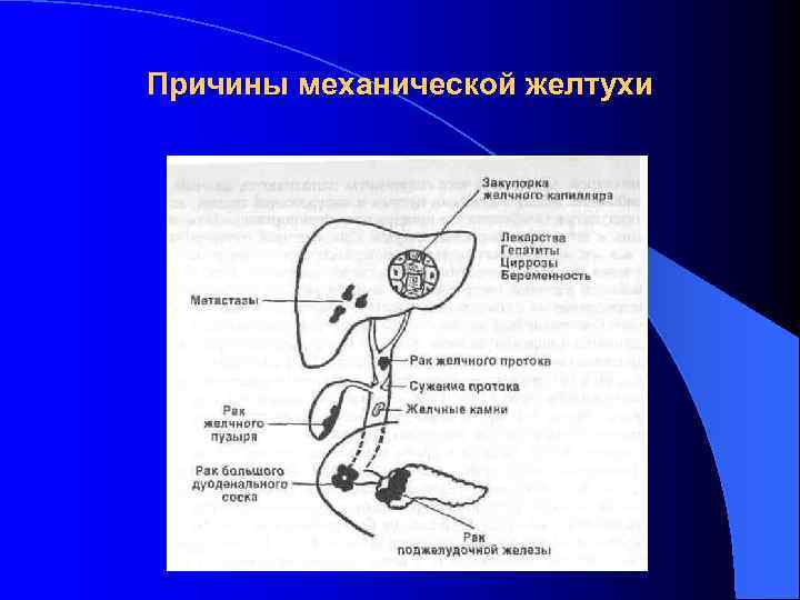 Механическая желтуха хирургия презентация