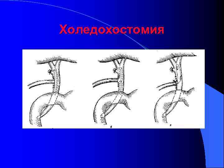 Холедохостомия 