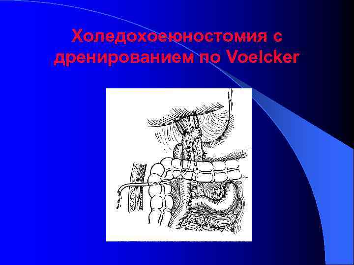 Холедохоеюностомия с дренированием по Voelcker 