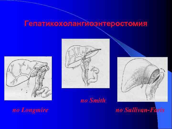 Гепатикохолангиоэнтеростомия по Smith по Longmire по Sullivan-Faris 