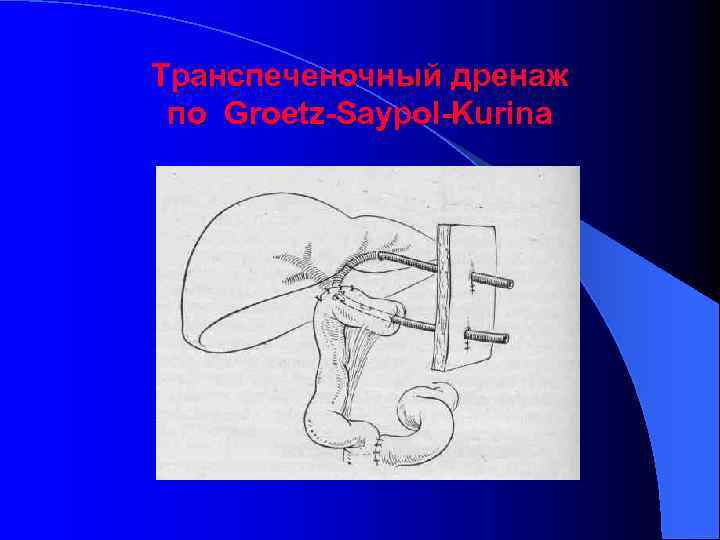 Транспеченочный дренаж по Groetz-Saypol-Kurina 