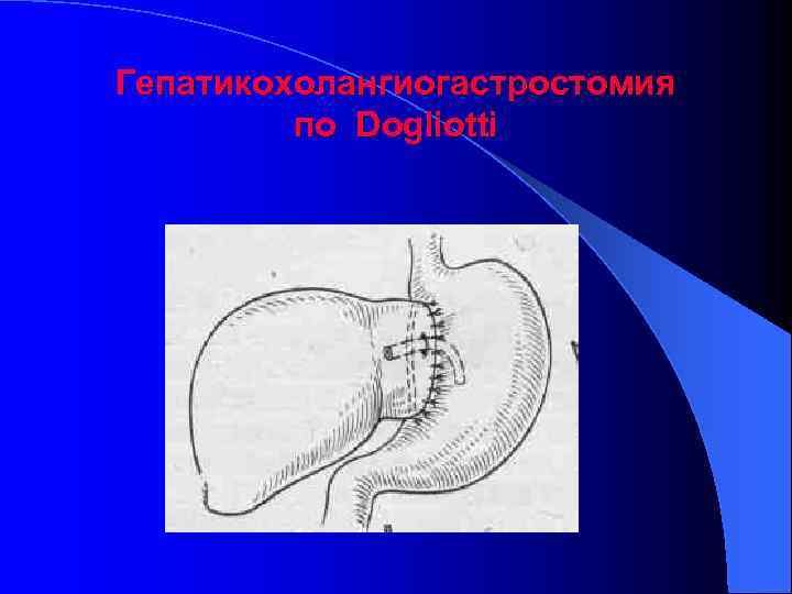Гепатикохолангиогастростомия по Dogliotti 