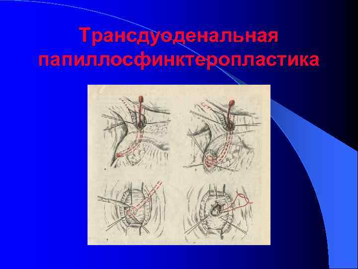 Трансдуоденальная папиллосфинктеропластика 
