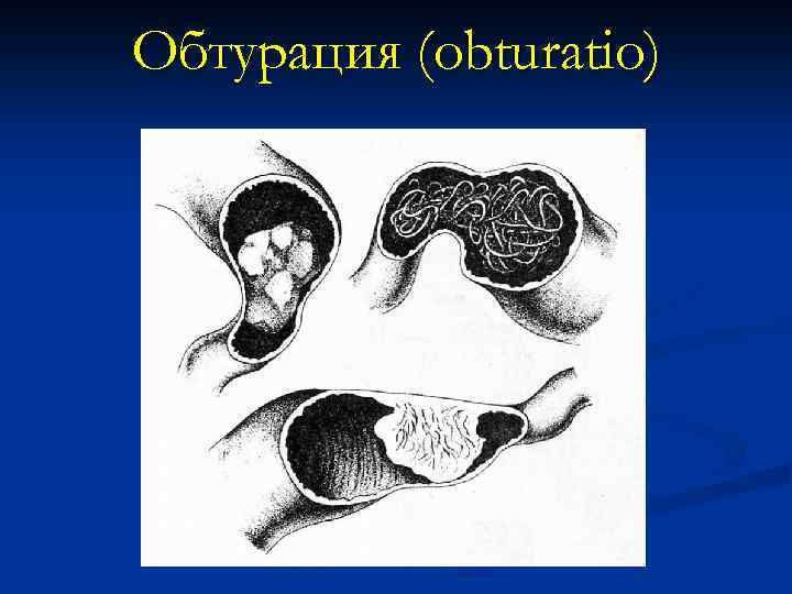 Обтурация (obturatio) 