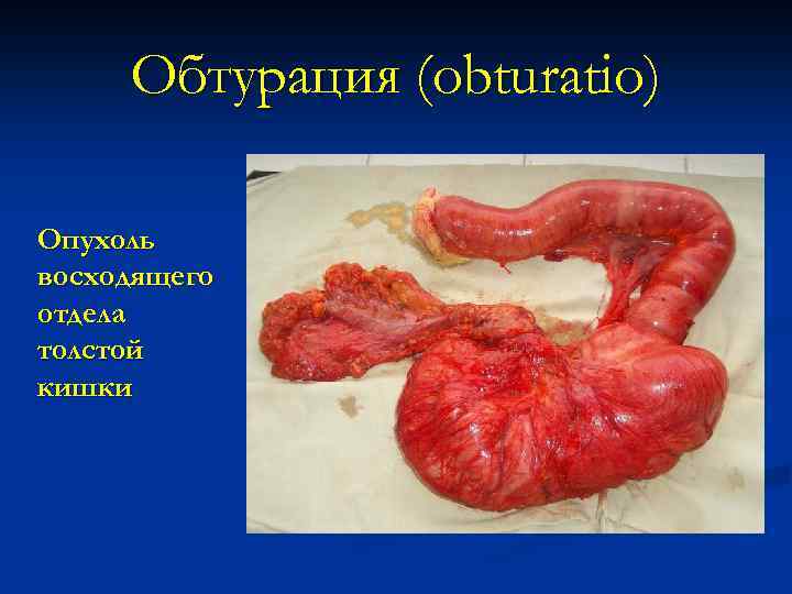 Обтурация (obturatio) Опухоль восходящего отдела толстой кишки 