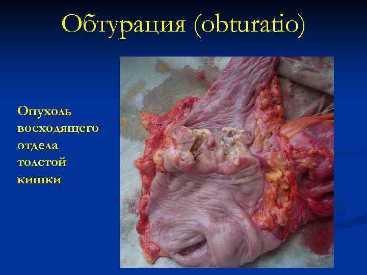 Обтурация (obturatio) Опухоль восходящего отдела толстой кишки 