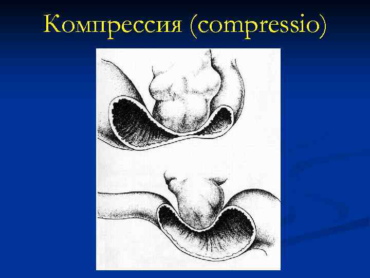 Компрессия (compressio) 