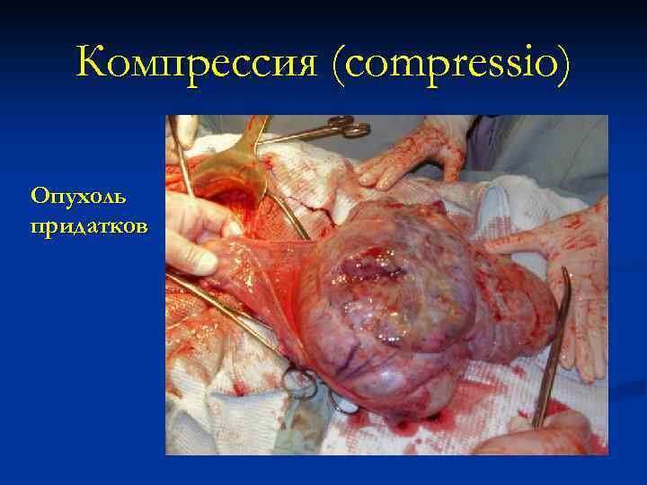 Компрессия (compressio) Опухоль придатков 