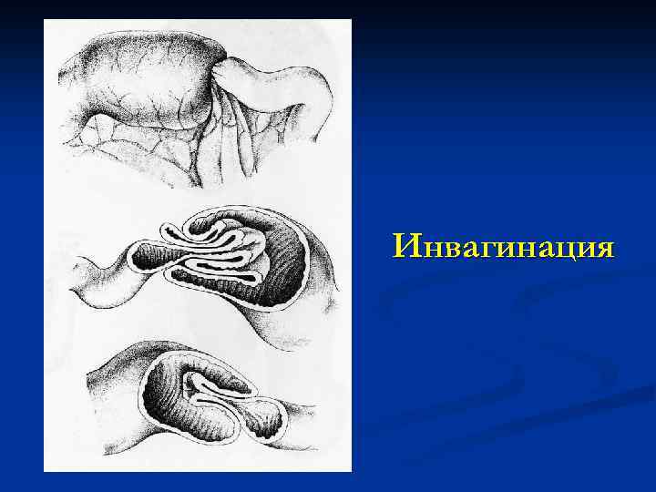 Илеоцекальная инвагинация кишечника. Инвагинация кишечника инвагинат. Инвагинация непроходимость кишечника. Острая кишечная непроходимость инвагинация.