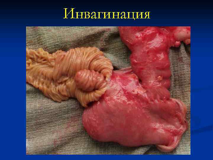 Инвагинация 