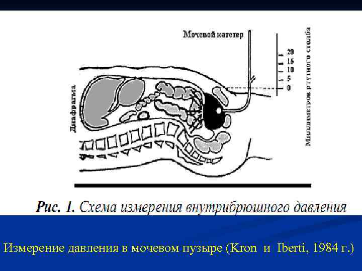 Измерение давления в мочевом пузыре (Kron и Iberti, 1984 г. ) 