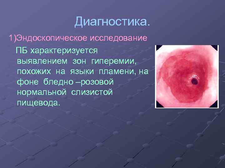 Диагностика. 1)Эндоскопическое исследование ПБ характеризуется выявлением зон гиперемии, похожих на языки пламени, на фоне