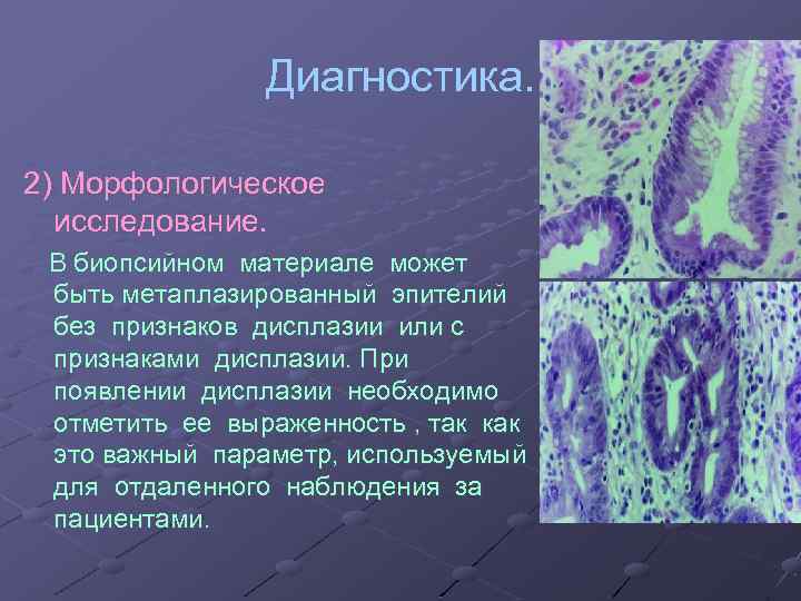 Диагностика. 2) Морфологическое исследование. В биопсийном материале может быть метаплазированный эпителий без признаков дисплазии