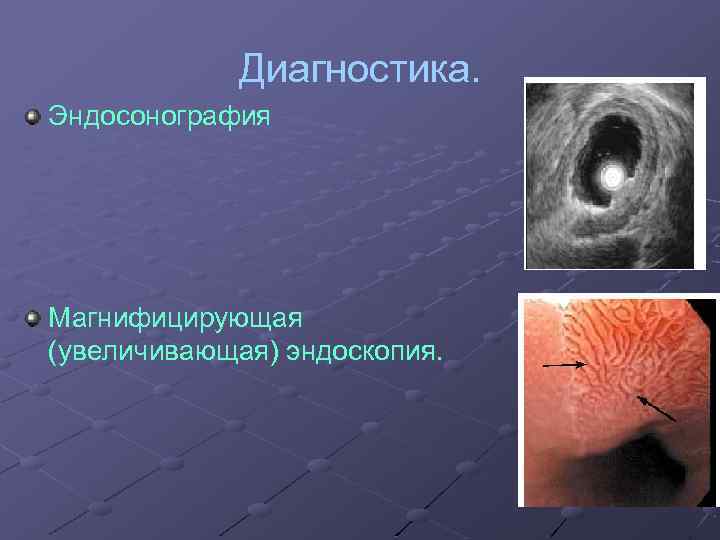 Диагностика. Эндосонография Магнифицирующая (увеличивающая) эндоскопия. 