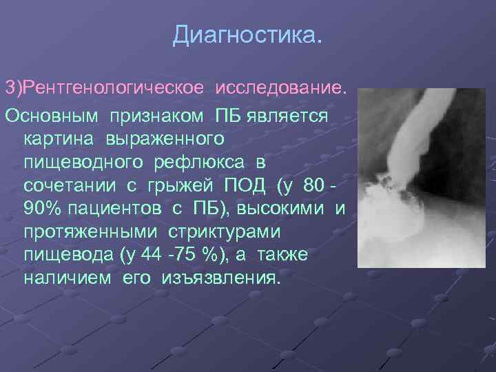 Диагностика. 3)Рентгенологическое исследование. Основным признаком ПБ является картина выраженного пищеводного рефлюкса в сочетании с