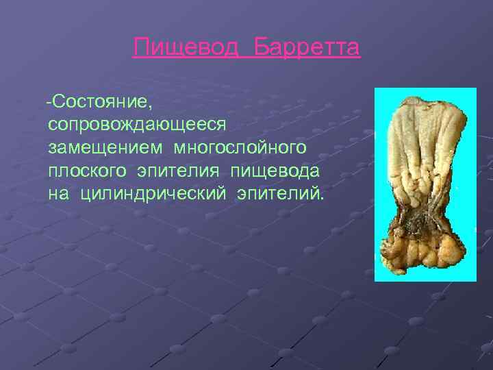 Пищевод Барретта -Состояние, сопровождающееся замещением многослойного плоского эпителия пищевода на цилиндрический эпителий. 