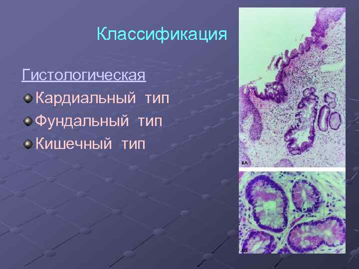 Классификация ПБ Гистологическая Кардиальный тип Фундальный тип Кишечный тип 