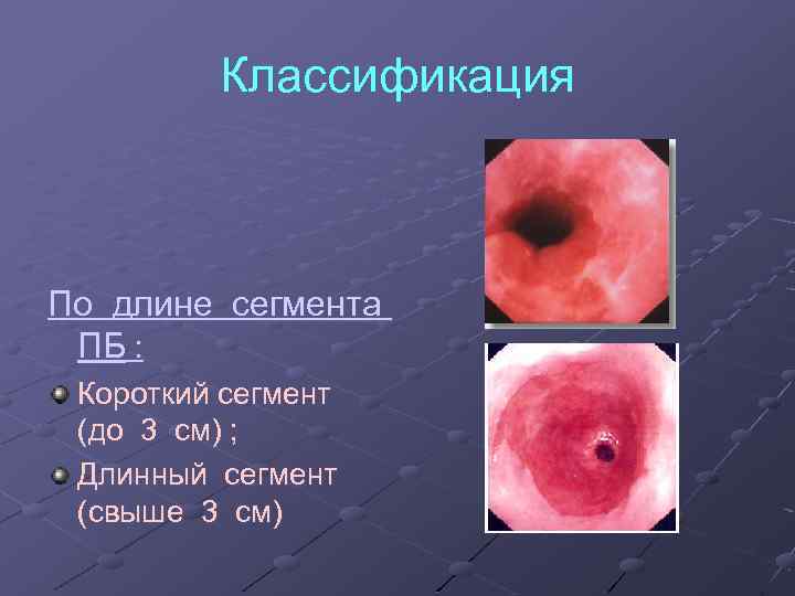 Классификация По длине сегмента ПБ : Короткий сегмент (до 3 см) ; Длинный сегмент