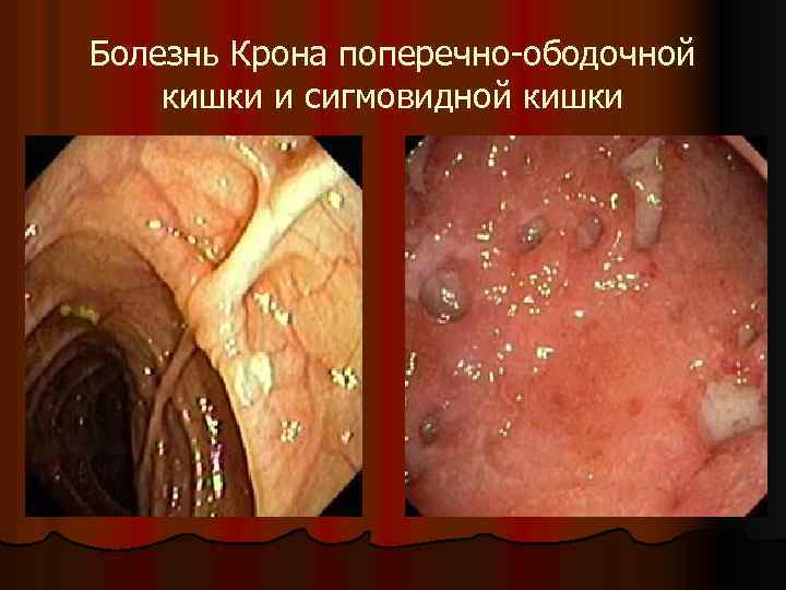 Болезнь Крона поперечно-ободочной кишки и сигмовидной кишки 