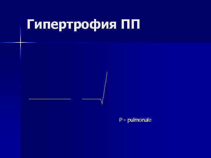 Гипертрофия ПП Р - pulmonale 