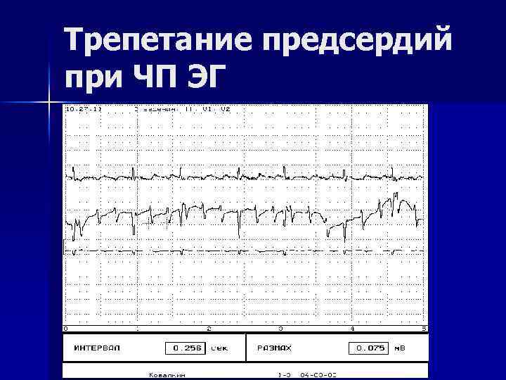 Трепетание предсердий при ЧП ЭГ 