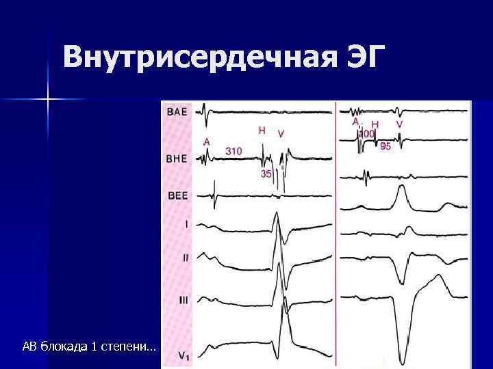  Внутрисердечная ЭГ АВ блокада 1 степени… 