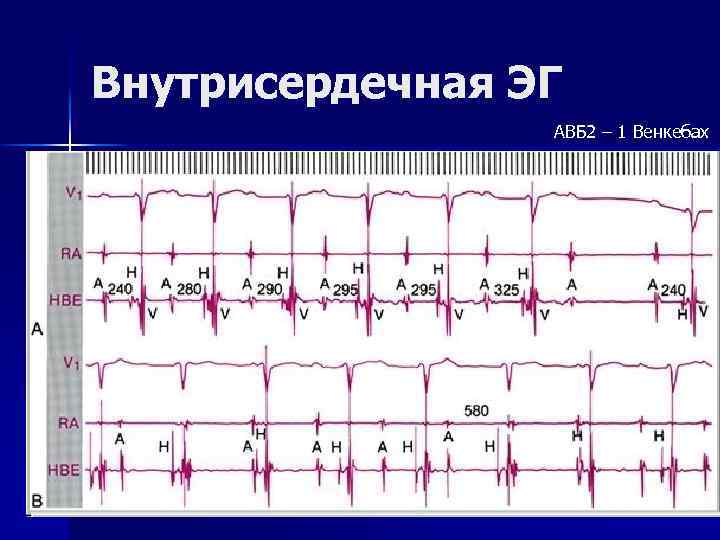 Внутрисердечная ЭГ АВБ 2 – 1 Венкебах 