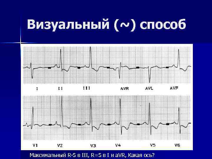 Визуальный (~) способ Максимальный R-S в III, R=S в I и a. VR, Какая