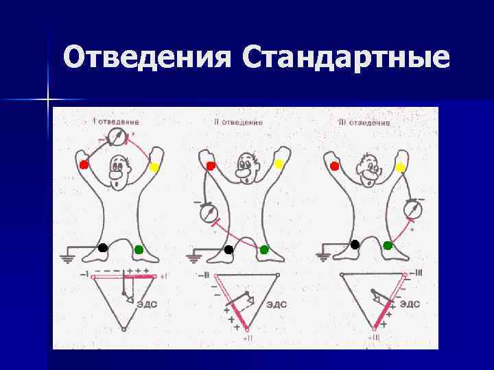 Отведения Стандартные 