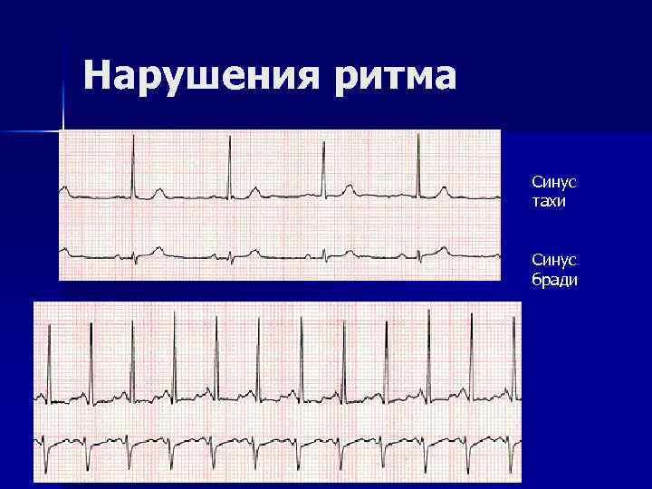 Нарушения ритма Синус тахи Синус бради 