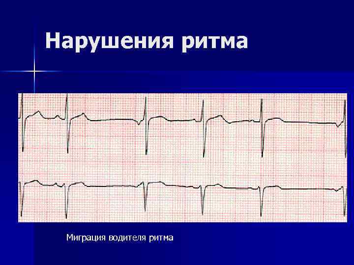 Нарушения ритма Миграция водителя ритма 