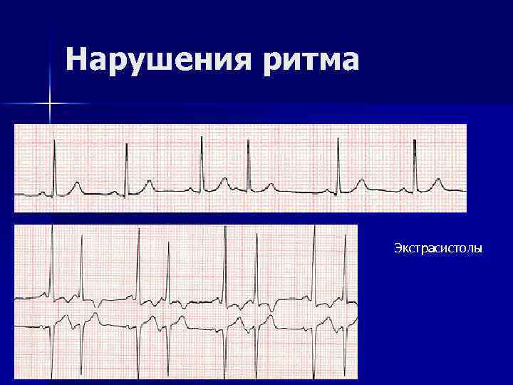 Нарушения ритма Экстрасистолы 