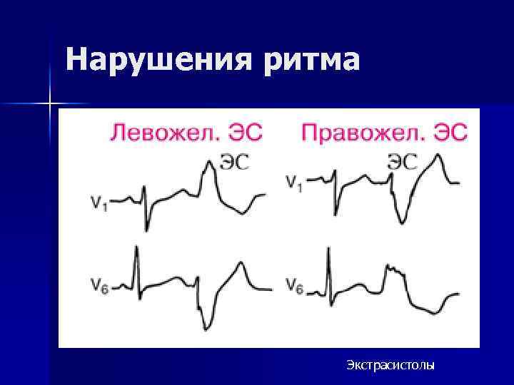 Нарушения ритма Экстрасистолы 