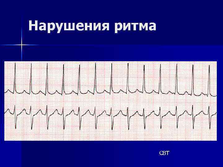 Нарушения ритма СВТ 