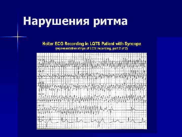 Нарушения ритма 