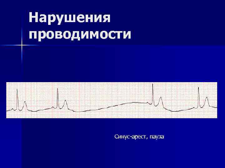 Нарушения проводимости Синус-арест, пауза 